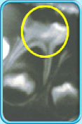 圖中所見是一張X光片，顯示一顆牙髓已壞死的乳臼齒。