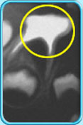 圖中所見是一張X光片，顯示一顆接受了清除全部牙髓的治療之後的乳臼齒。