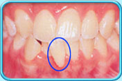 Photograph showing a tooth requiring removal for orthodontic needs.
