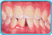 圖中所見是為配合牙齒矯正治療而需要拔掉的牙齒已給拔去。