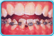 Photograph showing the lower teeth under orthodontic treatment with appliances.