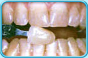 Photograph of front teeth with vital pulp in light brown colour before bleaching.