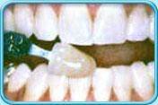 圖中所見是牙髓沒壞死的上下排前牙，於接受漂白治療後其表面呈乳白色。