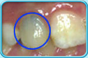 Photograph of teeth after pulp treatment showing discolouration before bleaching.