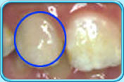 圖中所見是曾接受牙髓治療的牙齒，於接受漂白治療後其表面呈淡黃色。