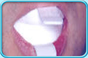 Photograph showing a custom made whitening tray ready to be worn by a patient for bleaching the teeth.