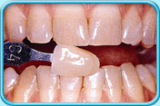 Photograph showing front teeth before bleaching. They look light brown.