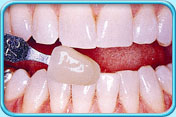 圖中所見是上下排前牙於接受漂白治療後的外觀，可見其表面呈乳白色。