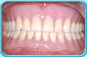 Photograph showing the appearance of a patient wearing a complete denture.