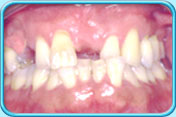 图中所见是病人口腔内没配戴假牙托时上下牙列的外貌。