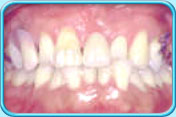 Photograph showing the appearance of a patient after wearing denture.