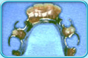 Photograph of a partial denture.