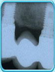 Photograph of an x-ray film showing the fitting of a bridge on the fixtures to replace the lost teeth.