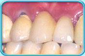 图中所见是上颌的植体跟牙桥配合后，假牙与真牙并列的外观。