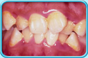 Photograph of irregular front teeth.