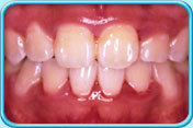 Photograph of irregular front teeth being moved to the desired positions after orthodontic treatment.