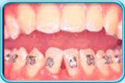 Photograph of lower front teeth with orthodontic brackets.