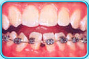 圖中所見是上下排前牙，下排牙齒表面都有橡筋圈和鋼絲，連繫牙齒矯正金屬弓絲和牙齒矯正器。