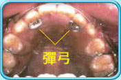 圖中所見是上頜和附在上頜的活動牙齒矯正器，並指出彈弓的所在位置。