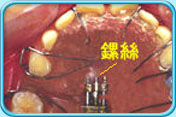 圖中所見是上頜和附在上頜的活動牙齒矯正器，並指出螺絲的所在位置。