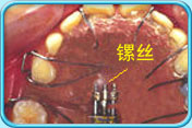 图中所见是上颌和附在上颌的活动牙齿矫正器，并指出螺丝的所在位置。