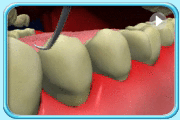 Animation showing the root planing procedure being performed by appropriate dental instruments for a patient with gum disease.