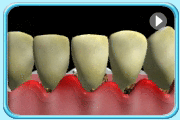 Animation showing the periodontal surgery being performed by appropriate dental instruments for a patient with severe gum disease.