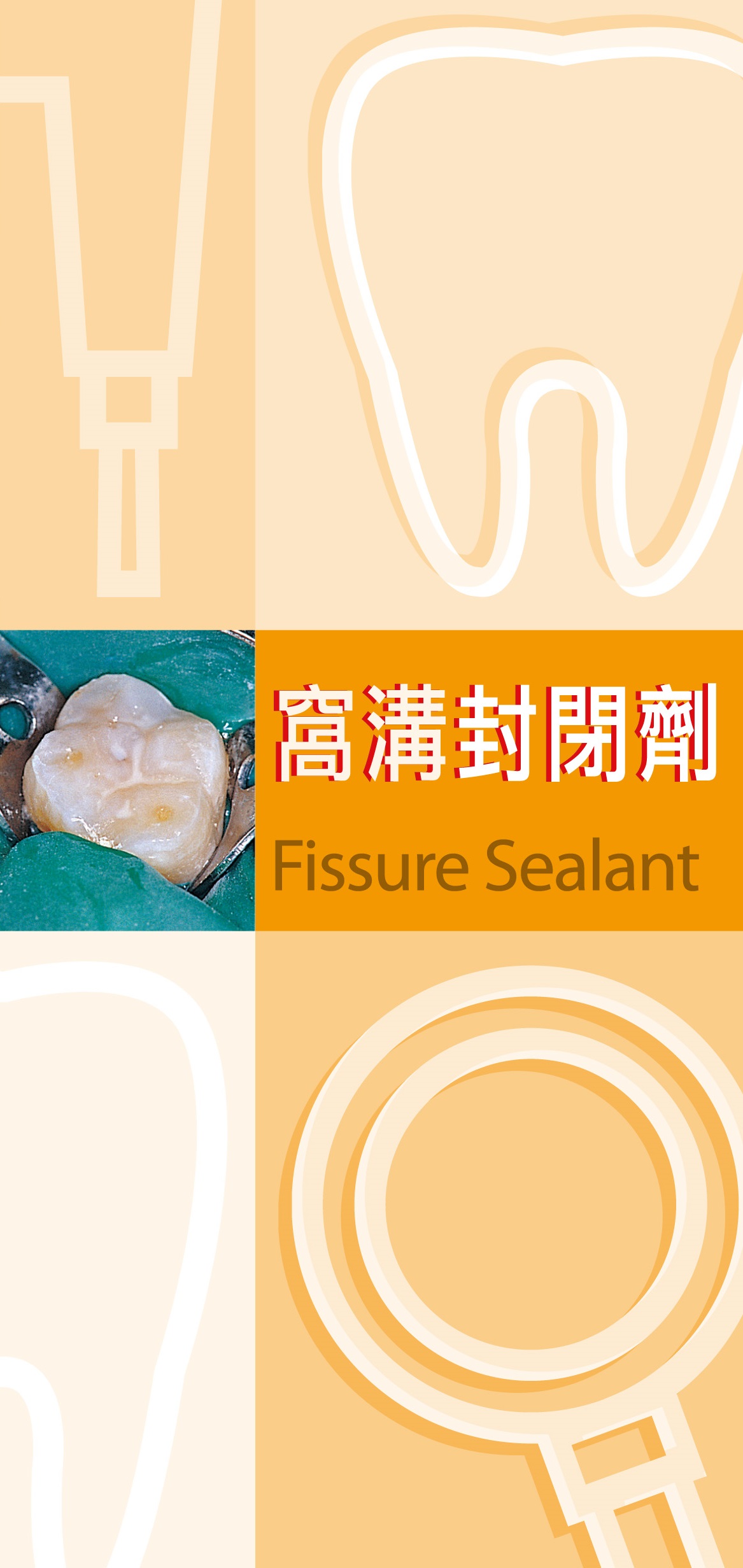 窩溝封閉劑（第一頁）