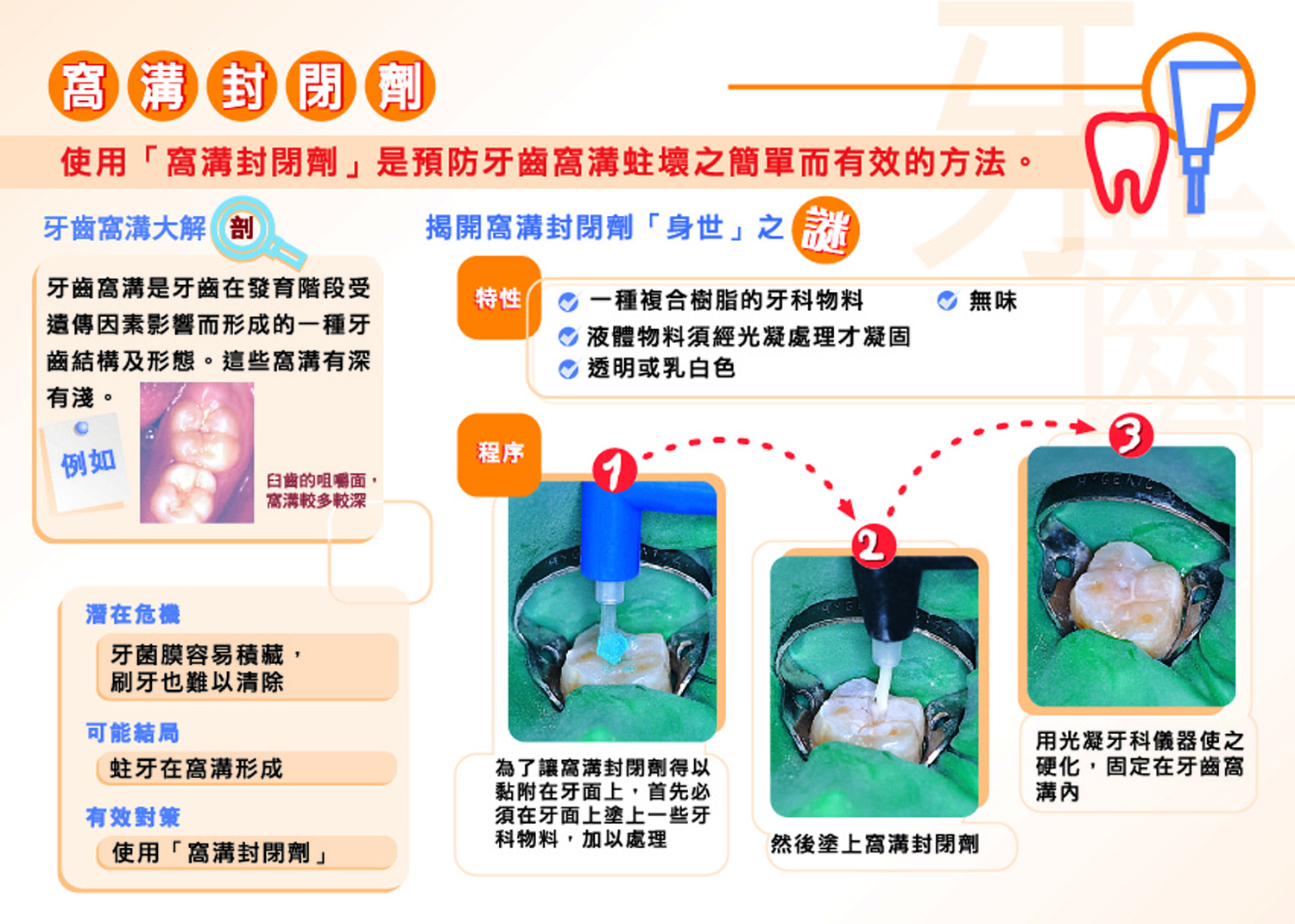 窩溝封閉劑（第二頁）
